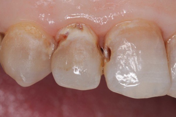 Tổng hợp các cách loại bỏ sâu kẽ răng tại nhà